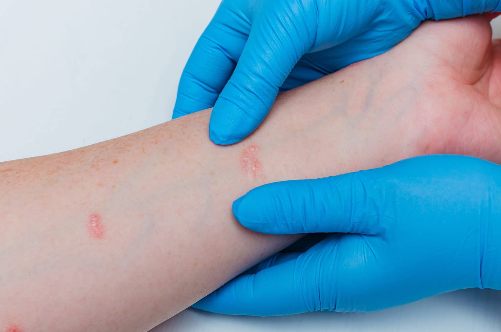 Stock photograph of models: blue-gloved hands examine a red rash on a forearm
